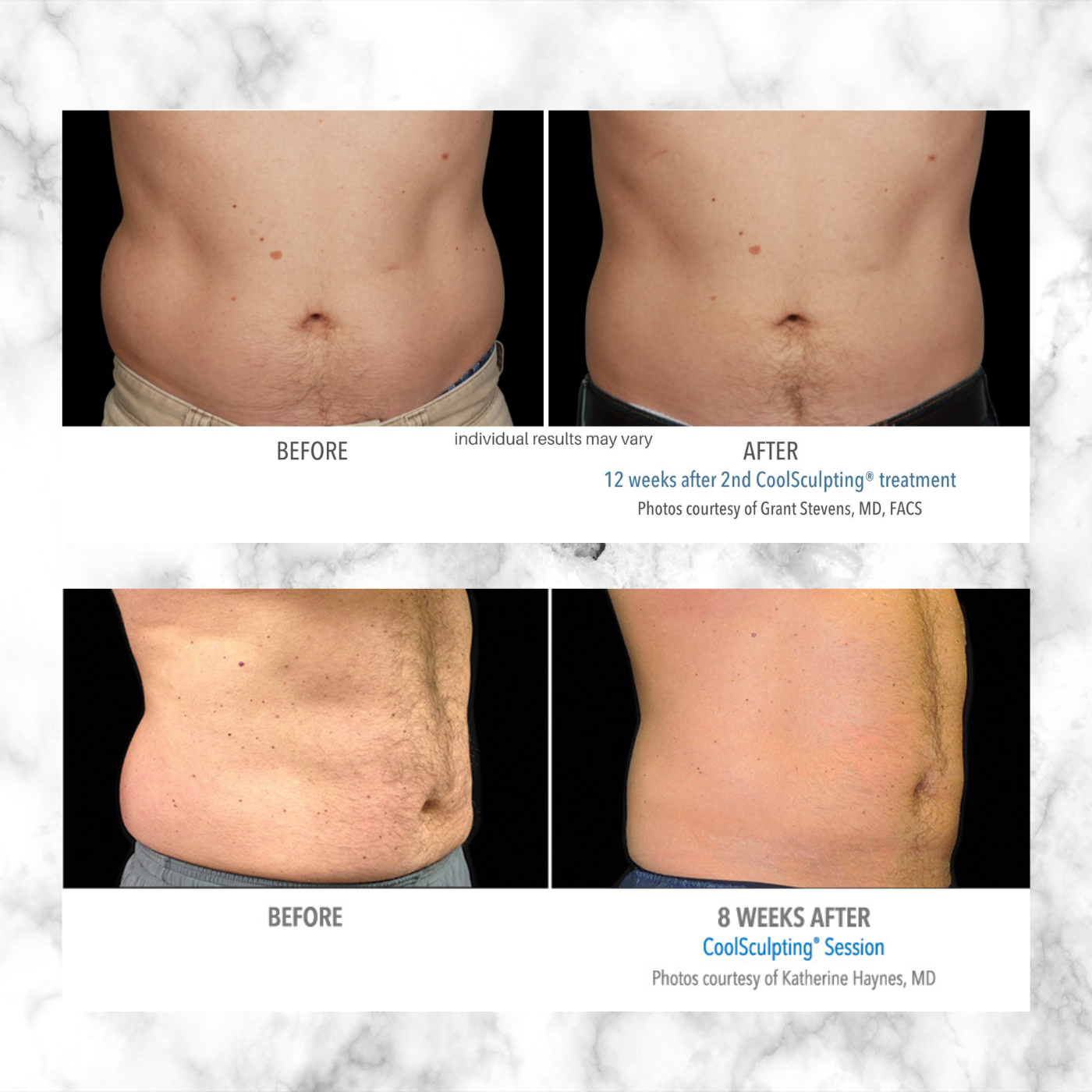 CoolSculpting Elite | PACKAGE of 8