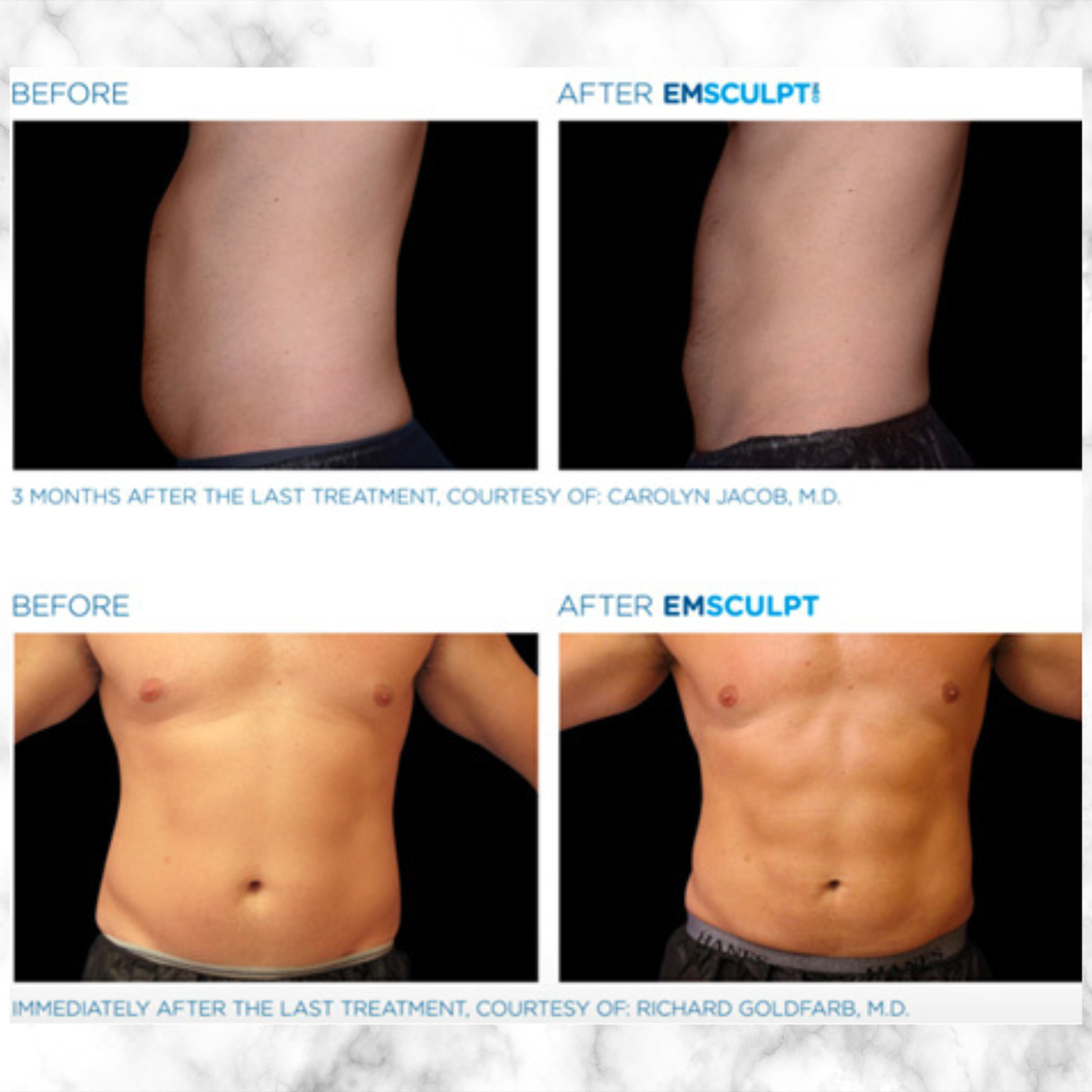 EmSculpt NEO | PACKAGE OF 4