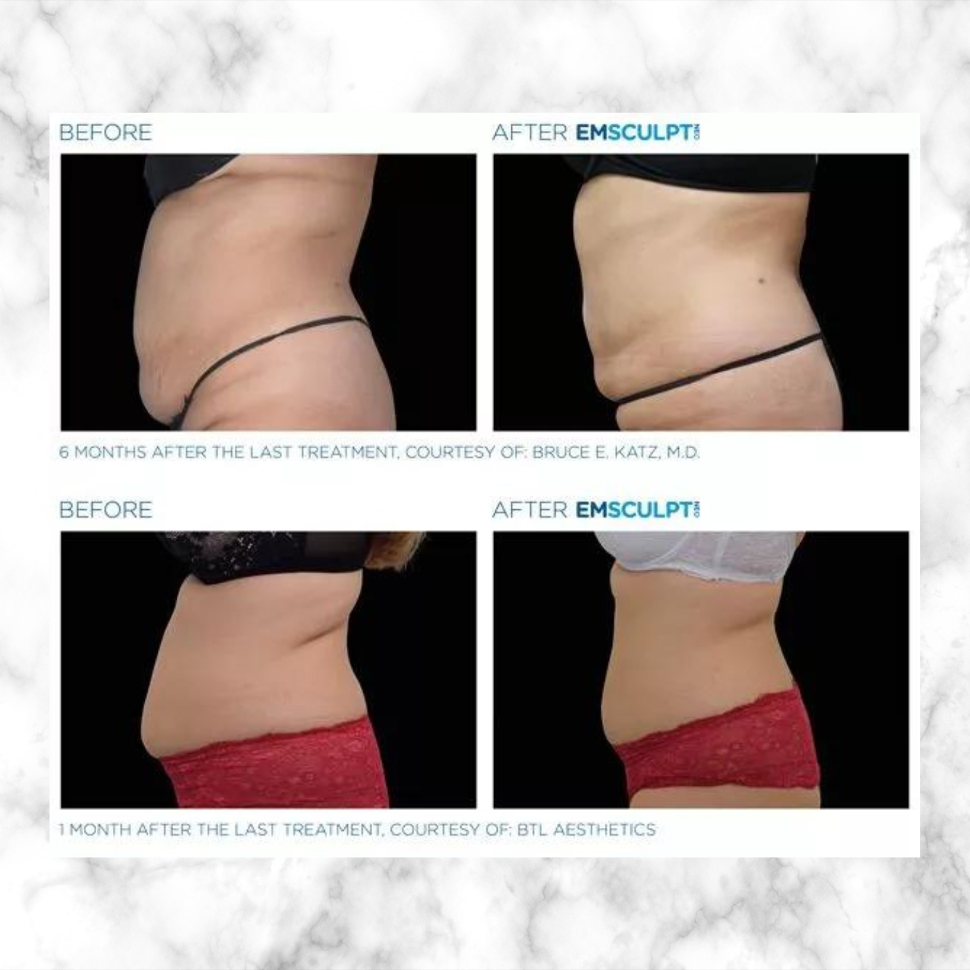 EmSculpt NEO | PACKAGE OF 4