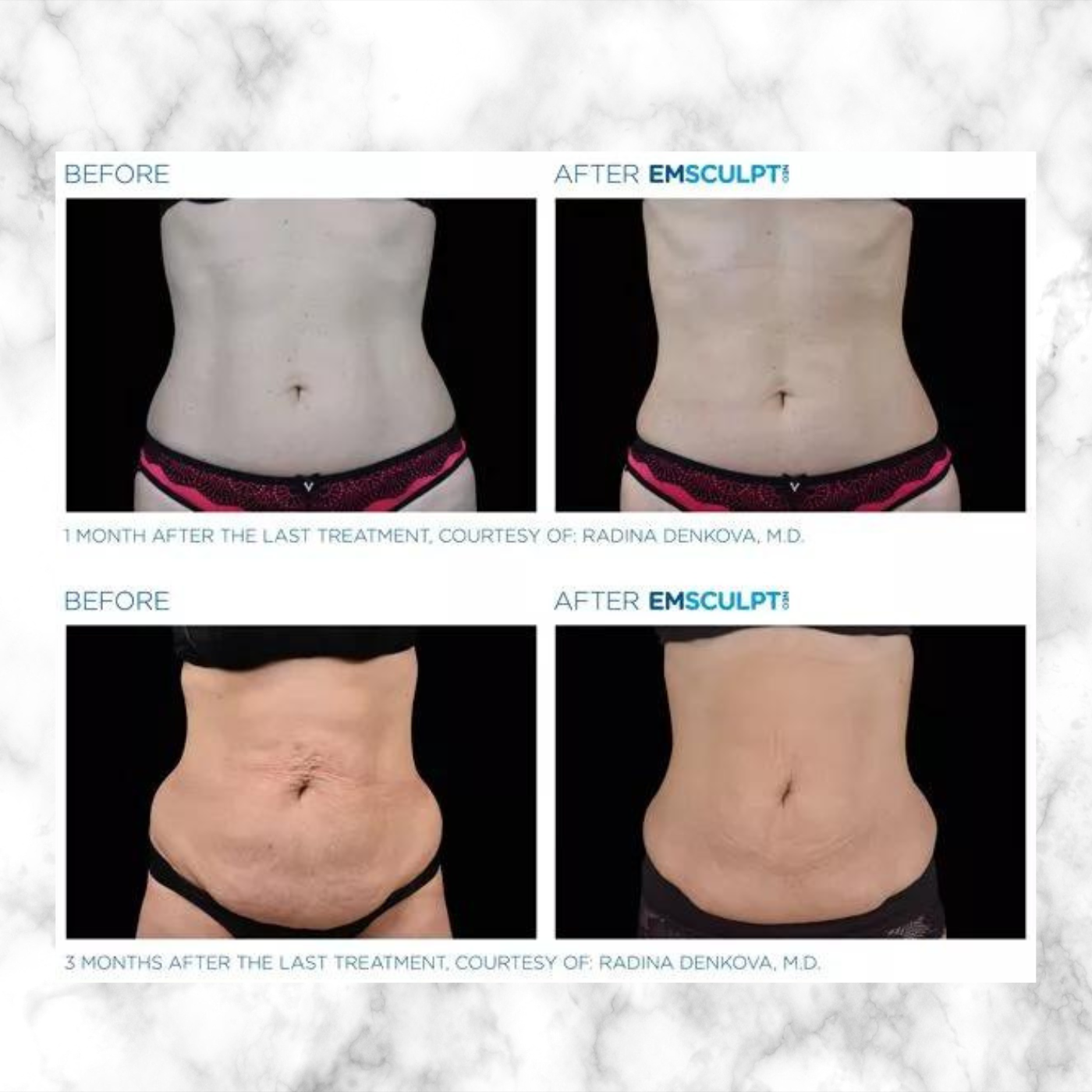 EmSculpt NEO | PACKAGE OF 4