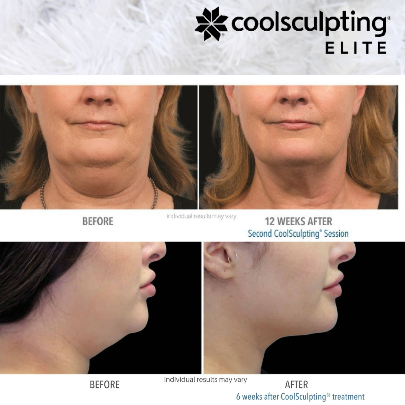 CoolSculpting Elite | PACKAGE of 8