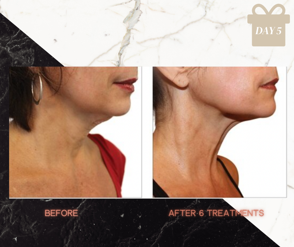 FULL FACE SKIN TIGHTENING PACKAGE OF 6