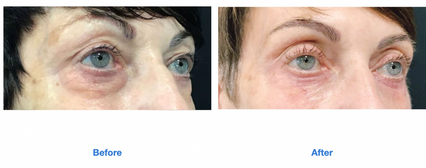 SOFWAVE | Brow + Under Eye Lift | Limited Time Offer