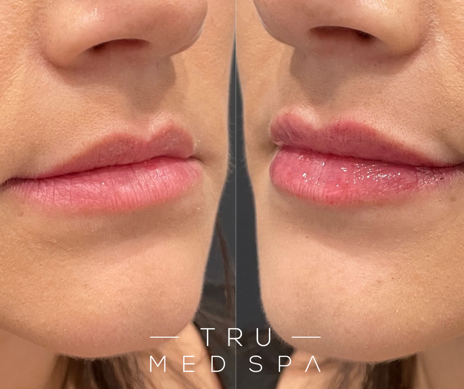 JUVEDERM XC OR XC PLUS | 1 SYRINGE | $100 OFF