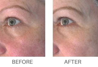 RF MICRONEEDLING | Pack of 3 | Collagen Induction Therapy