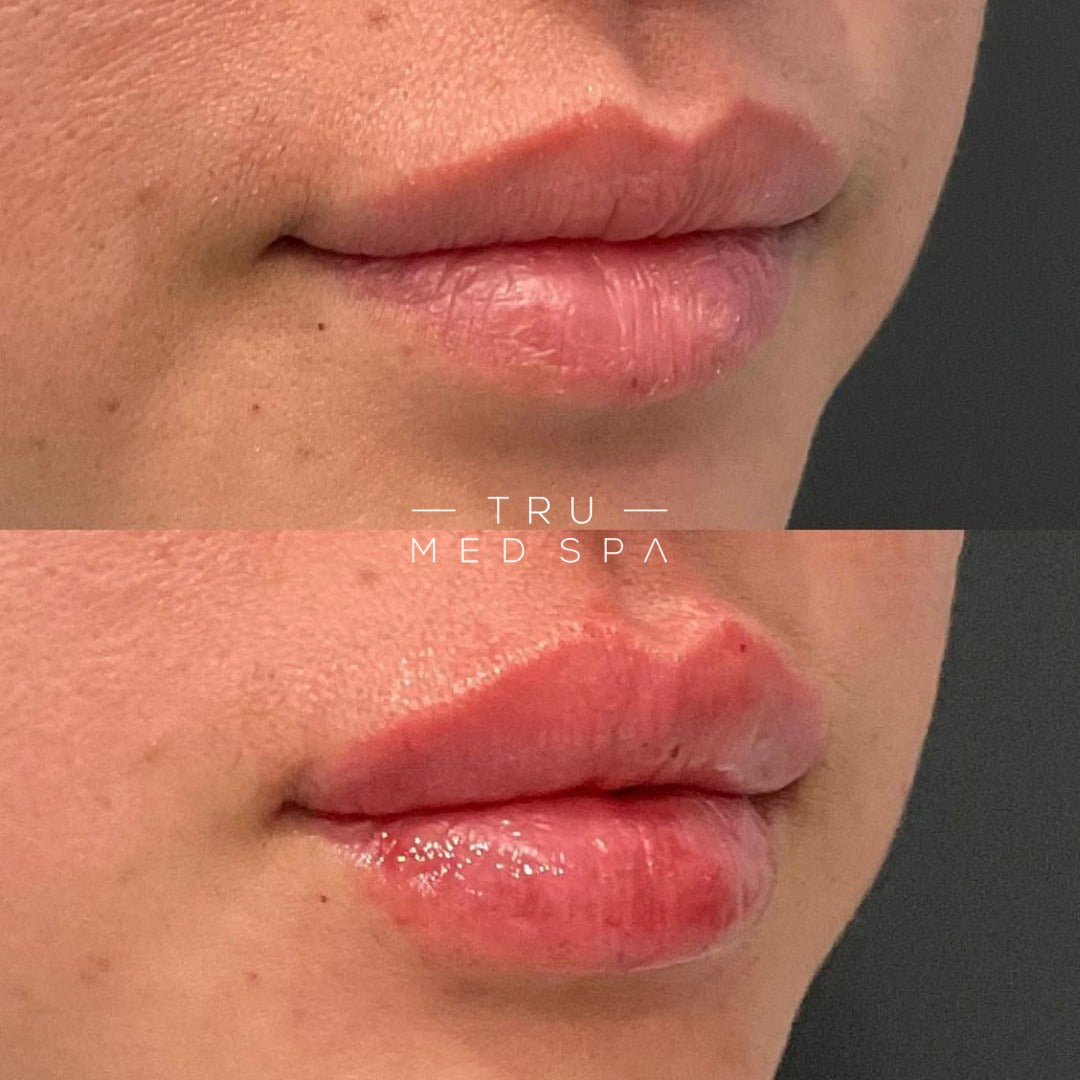 Mini Lip & Toxin | Erase Lines & Enhance Your Lips
