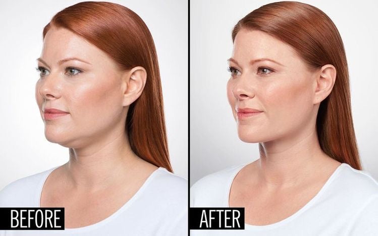 Kybella | Non Surgical Double Chin Removal $100 OFF