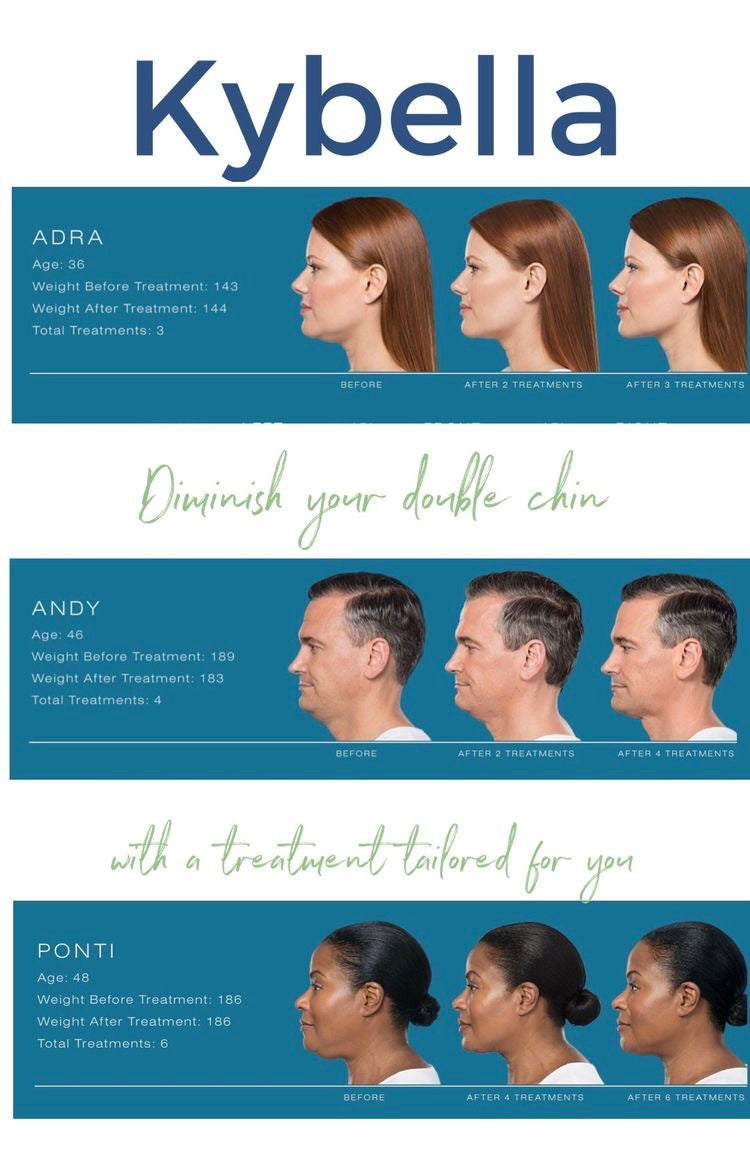 Kybella | Non Surgical Double Chin Removal $100 OFF