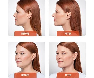 Kybella | Non Surgical Double Chin Removal $100 OFF