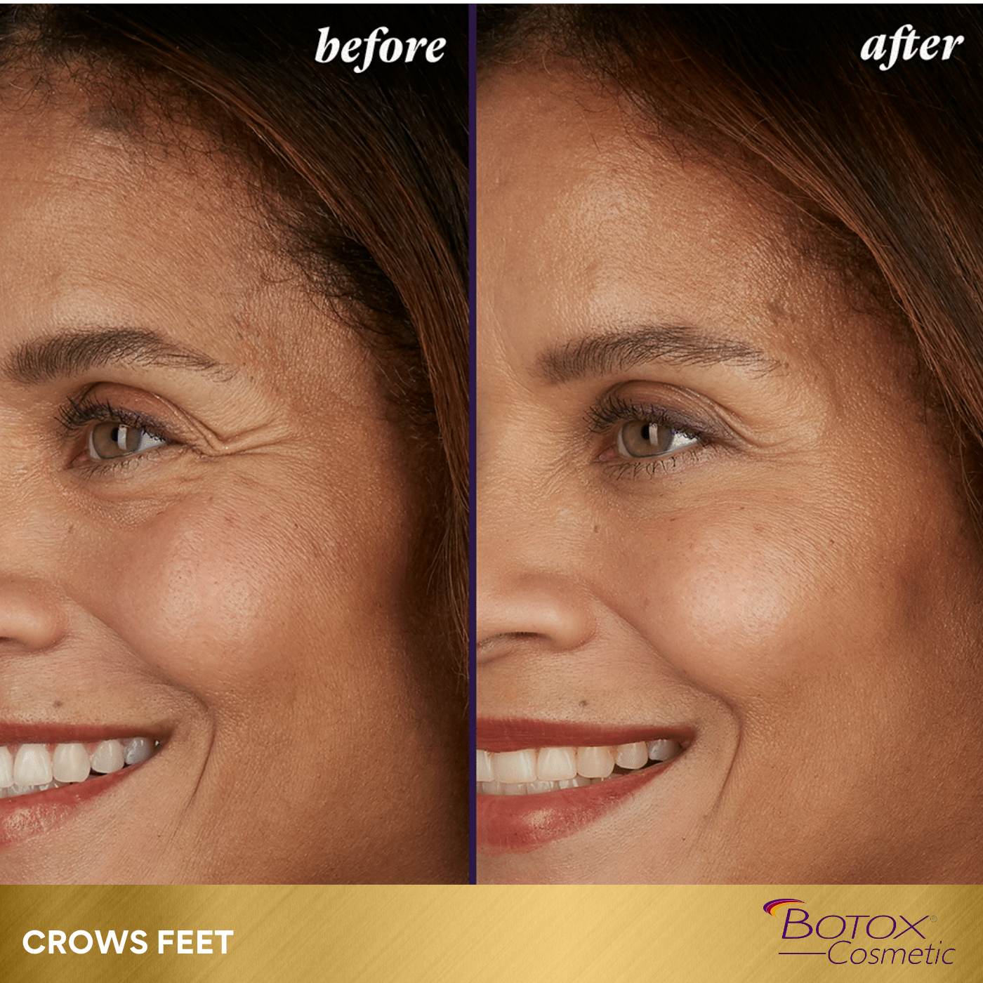 BOTOX SPECIAL | 60 UNITS