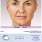 JUVEDERM XC OR XC PLUS | 1 SYRINGE | $100 OFF