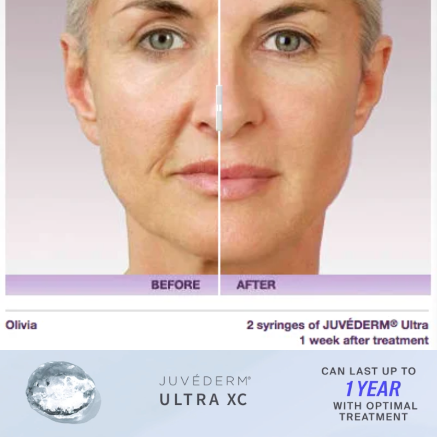 JUVEDERM XC OR XC PLUS | 1 SYRINGE | $100 OFF