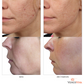 VENUS VIVA | SKIN RE-SURFACING | Package of 3