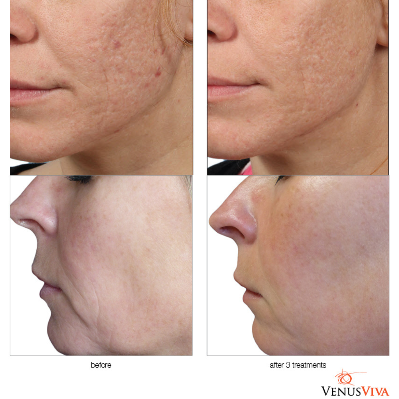 VENUS VIVA | SKIN RE-SURFACING | Package of 3