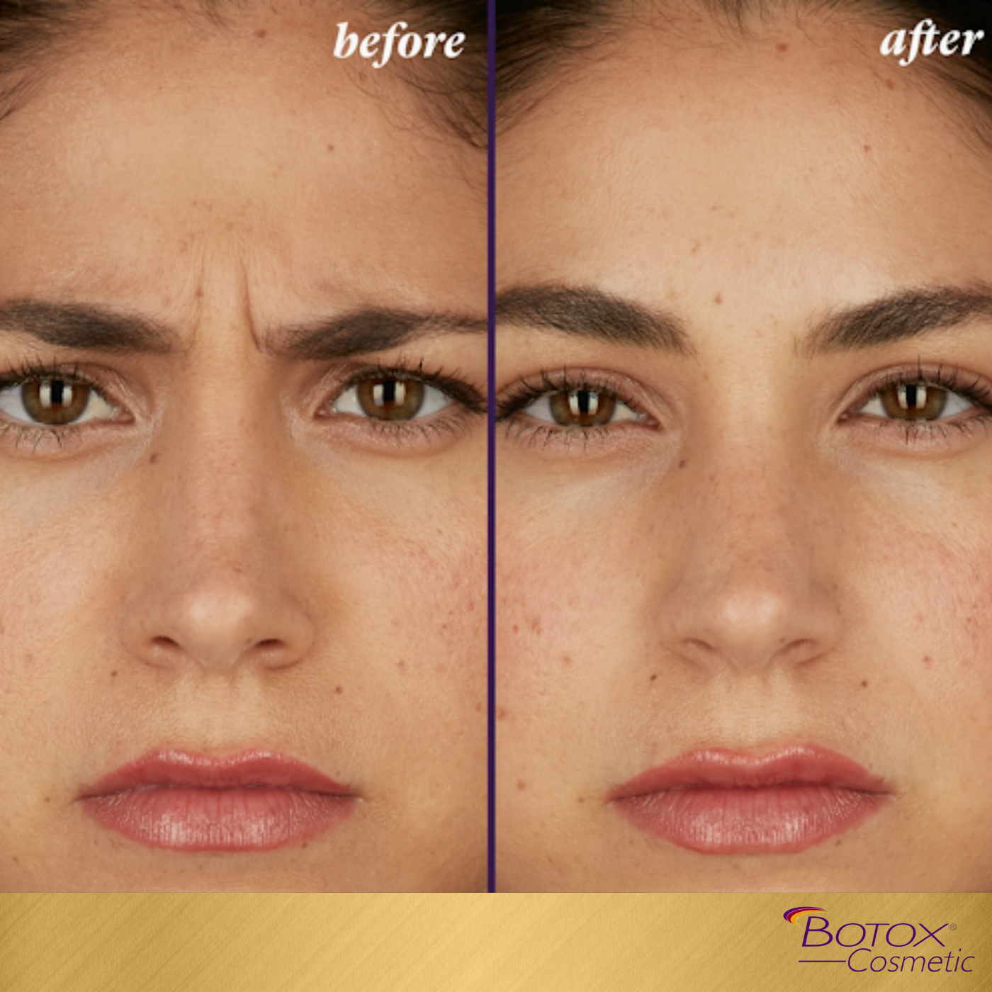 BOTOX SPECIAL | 20 UNITS for $220