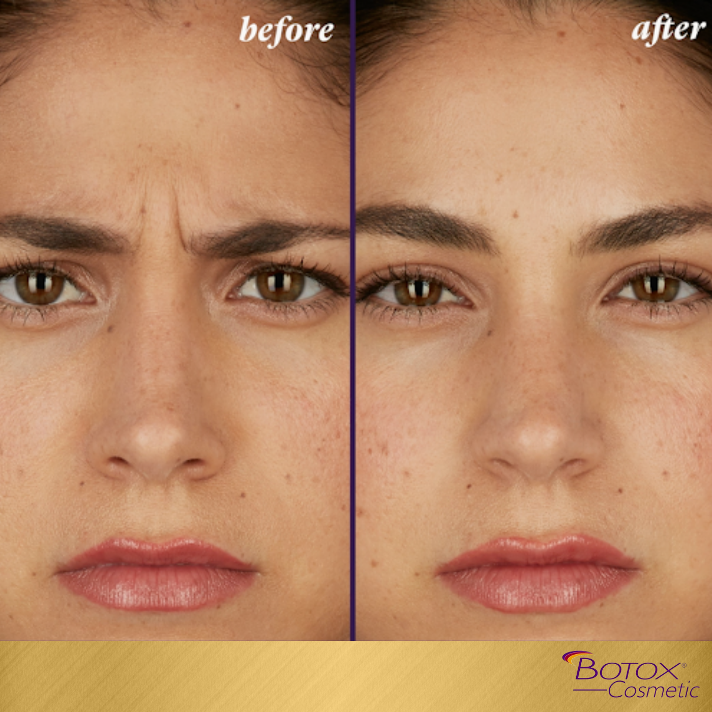 BOTOX SPECIAL | 60 UNITS