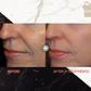 FULL FACE SKIN TIGHTENING PACKAGE OF 6
