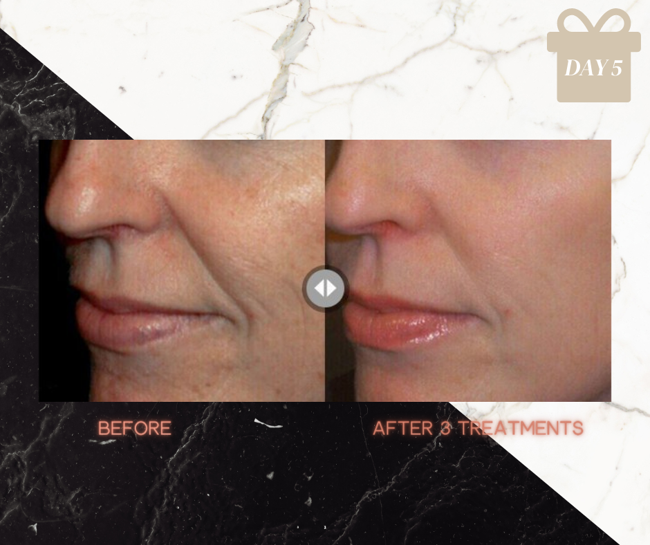 FULL FACE SKIN TIGHTENING PACKAGE OF 6