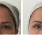 SOFWAVE | Brow + Under Eye Lift | Limited Time Offer